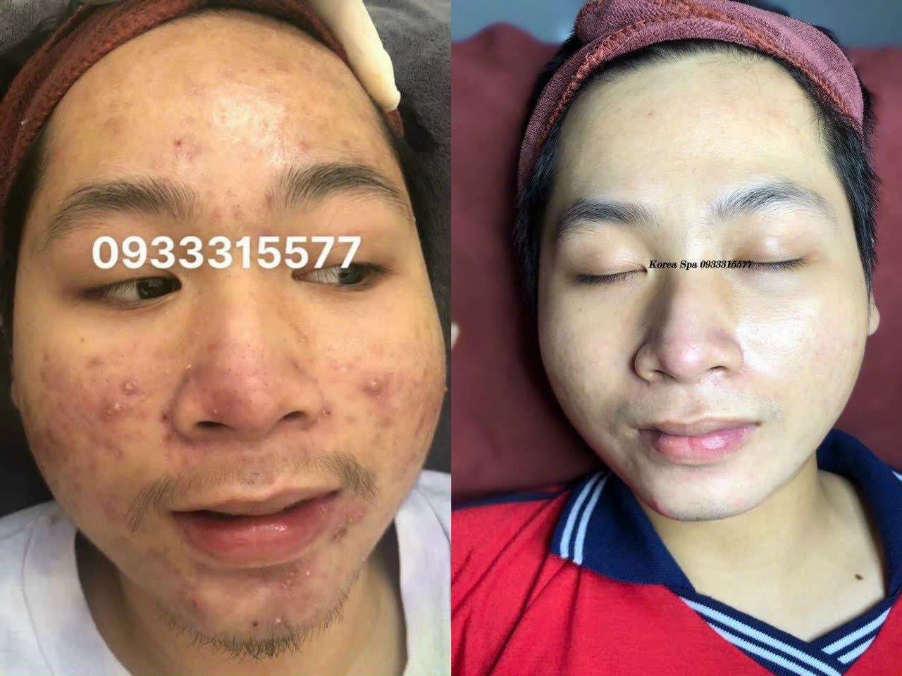 Korea Spa - Spa Chuyên điều trị mụn nám tàn nhang và tắm trắng tại Đường Phạm Thị Giây Hóc Môn