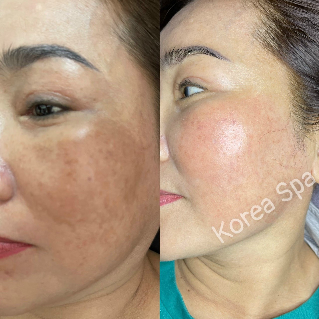 Korea Spa - Spa Chuyên điều trị mụn nám tàn nhang và tắm trắng tại Đường Phạm Thị Giây Hóc Môn