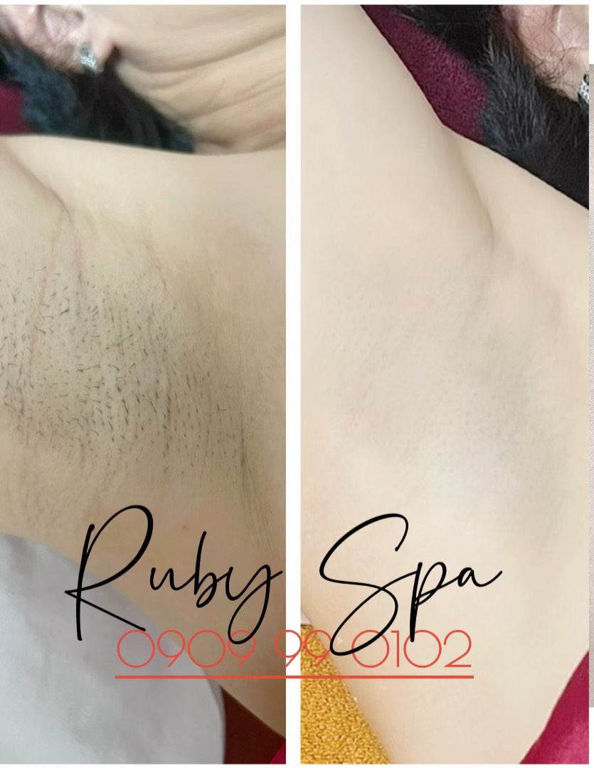 Ruby Spa - Spa Chuyên điều trị hôi nách thâm nách, làm hồng vùng kín số 1 Hóc Môn