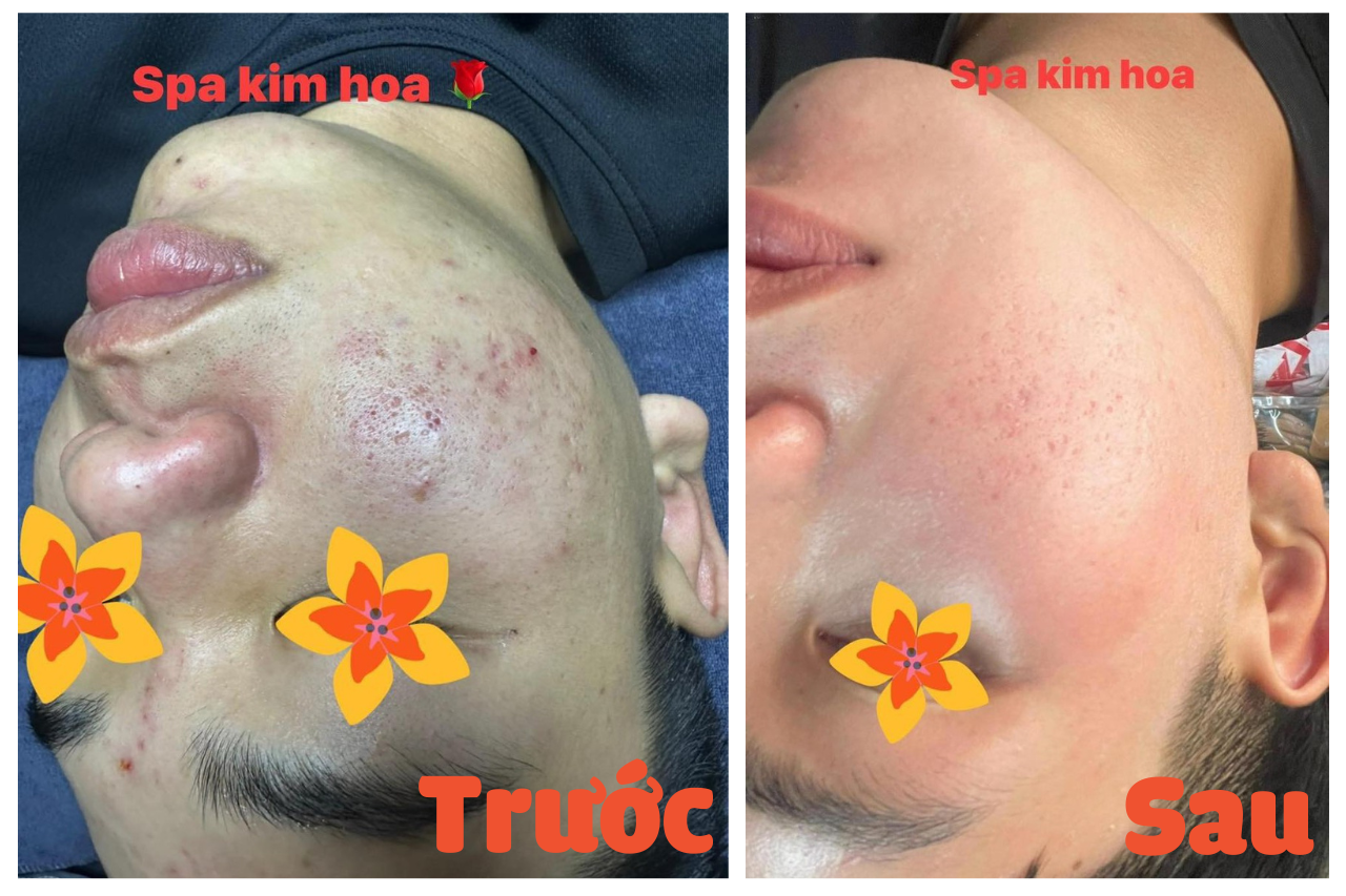 spa kim hoa nơi điều trị da trị mụn uy tín hóc môn