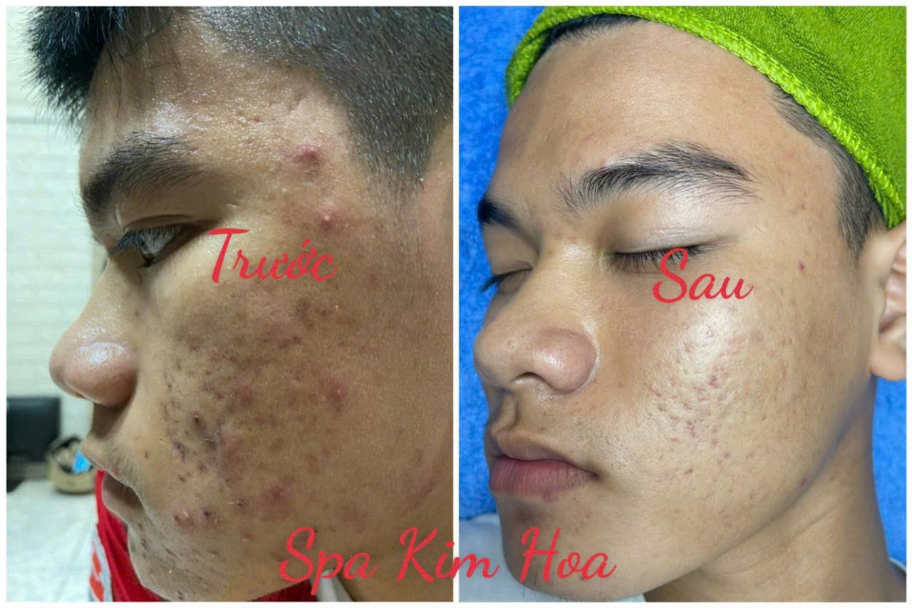 spa kim hoa nơi điều trị da trị mụn uy tín hóc môn